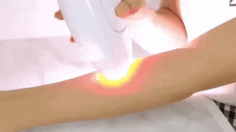 Depiladora Laser Ipl